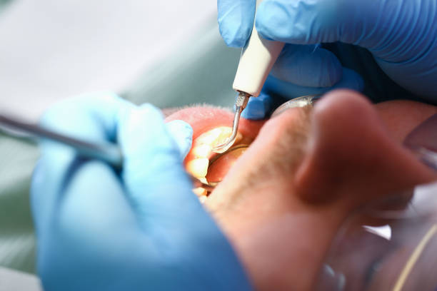 Best Dentist for Tooth Abscess  in Damascus, MD